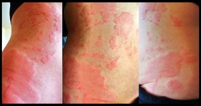 do hives itch more as they heal