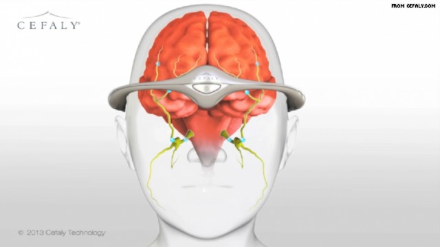 Can A New Device, Cefaly®, Help to Prevent Migraines?