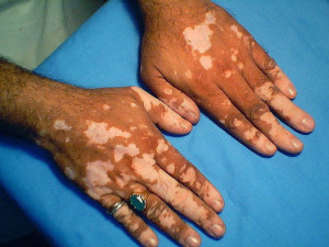 vitiligo_fingersInVite