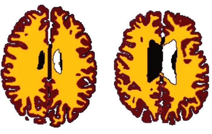 Middle-aged? Being Overweight or Obese May Age Your Brain 10 Years