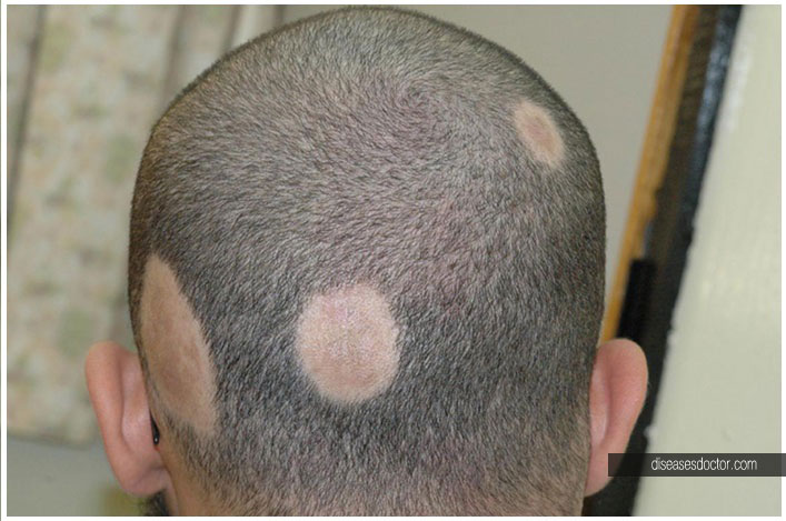 Alopecia Areata