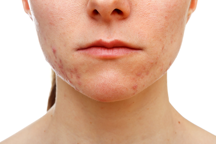 The Dirt on Skin Health: Adult-Onset Acne!