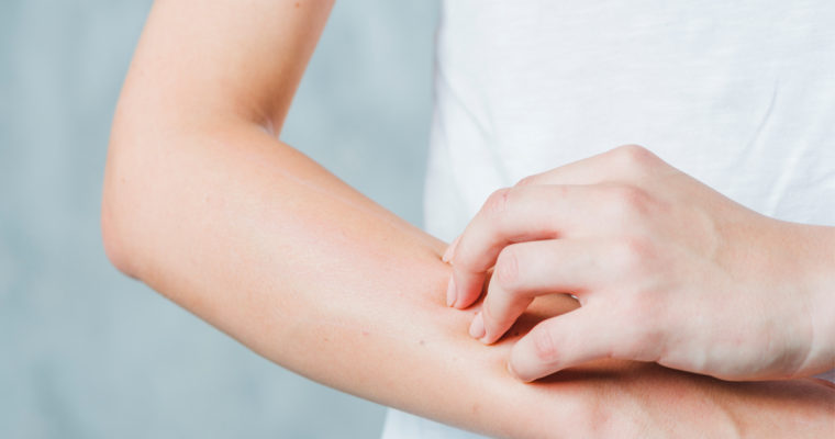 New Study: High Levels of Salt May Cause of Allergic Immune Reactions, Like Eczema
