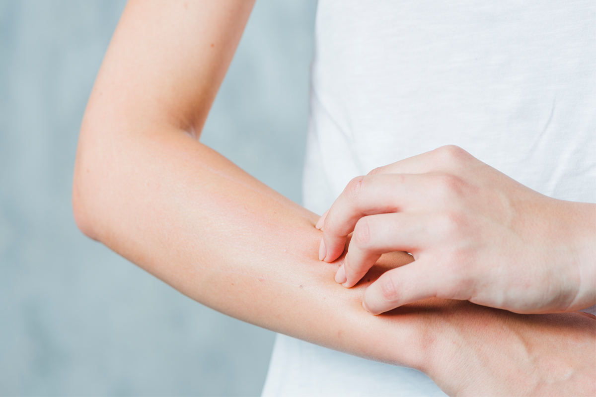 New Study: High Levels of Salt May Cause of Allergic Immune Reactions, Like Eczema