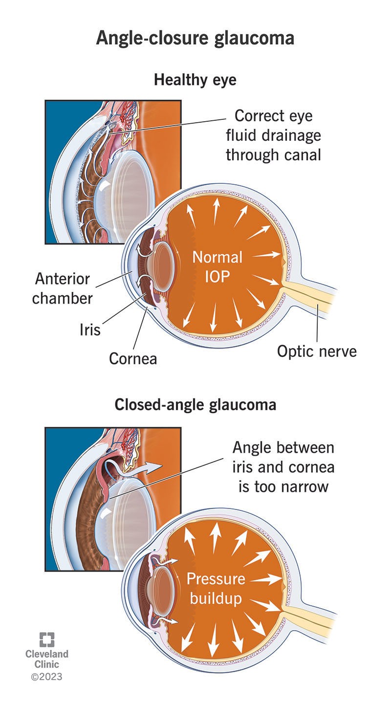 Glaucoma part 1 - InVite® Health Blog