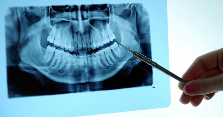 Dental Bone Loss