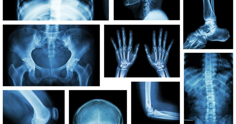 Strontium Citrate for Bone Health