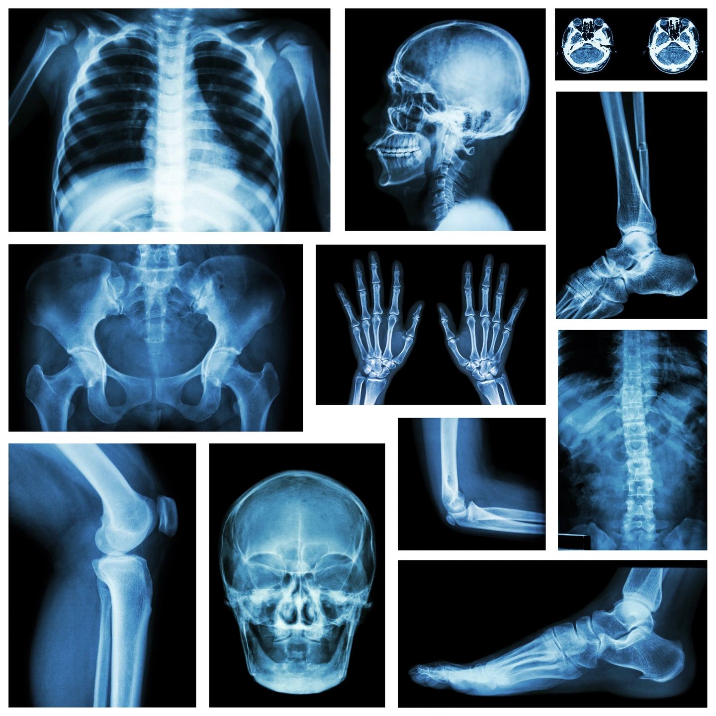 Strontium Citrate for Bone Health