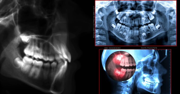 Dental Abscess and Cavities