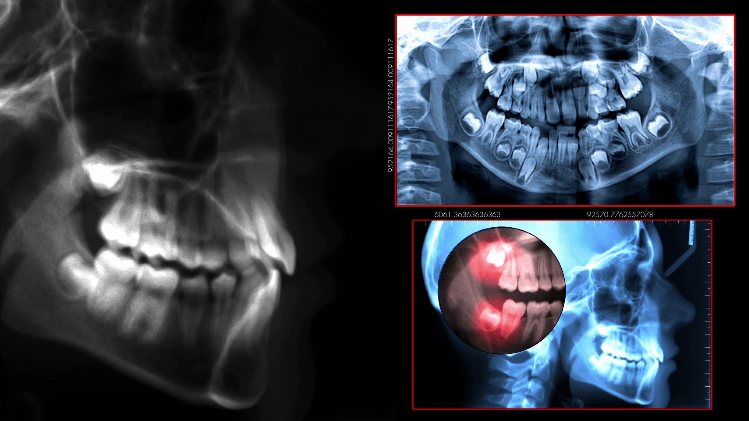 Dental Abscess and Cavities