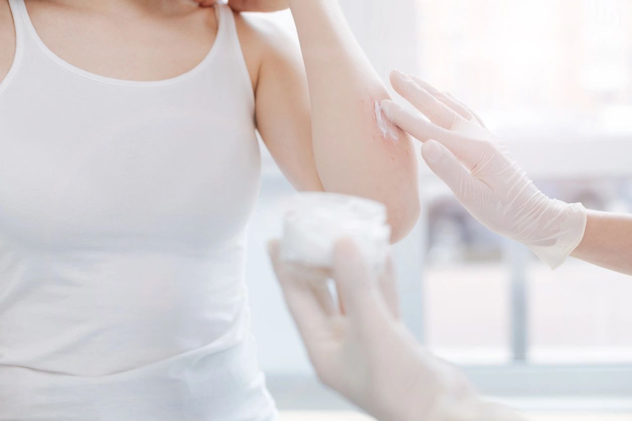 Skin Irritants of Summer part 1
